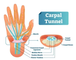 anatomi carpal tunnel syndrome