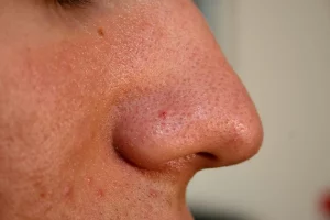 cara menghilangkan komedo di hidung
