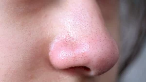 Cara Menghilangkan Komedo di Hidung