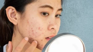 Cara Menghilangkan Komedo di Hidung