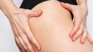 Cara Menghilangkan Stretch Mark