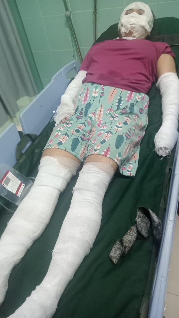 Ibu-ibu di Piyungan Bantul Alami Luka Bakar Serius Gegara Gas Melon Bocor
